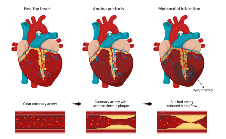 Heart Disease, Hypertension, High Blood Cholesterol - Heart Disease